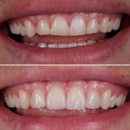 Veneers Vorher zu Nachher